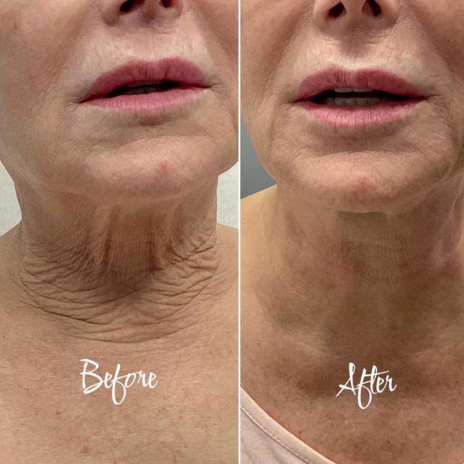 Before and After Treatment