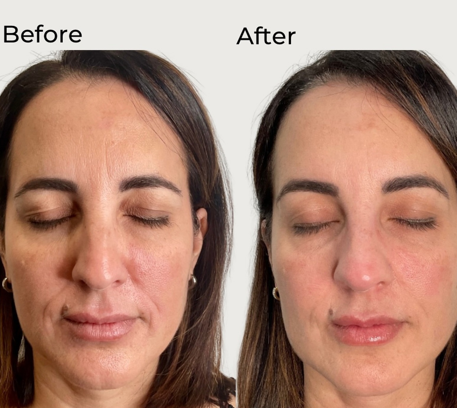 Rejuvenate Naturally: Everything You Need to Know About Biostimulators