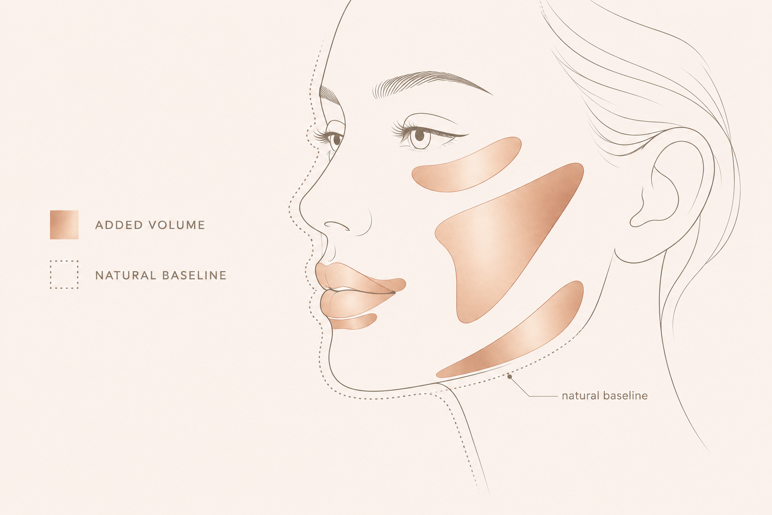 Can an Overfilled Face Be Corrected?