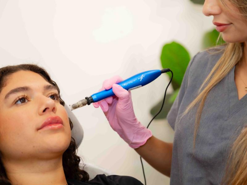 Microneedling treatment at Aesthetics by Yari